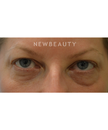 dr-baljeet-k-purewal-blepharoplasties-b