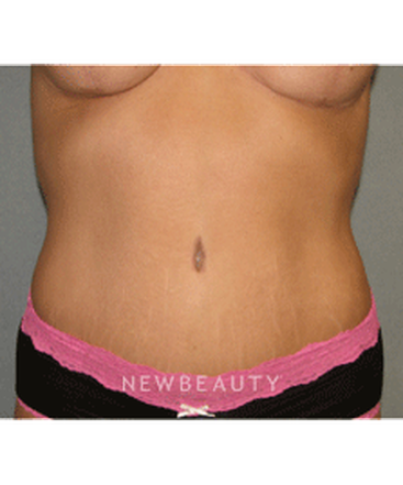 dr-sean-simon-tummy-tuck-lipo-b