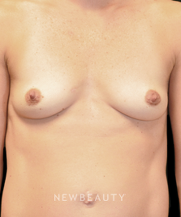 dr-andrew-smith-breast-augmentation-b