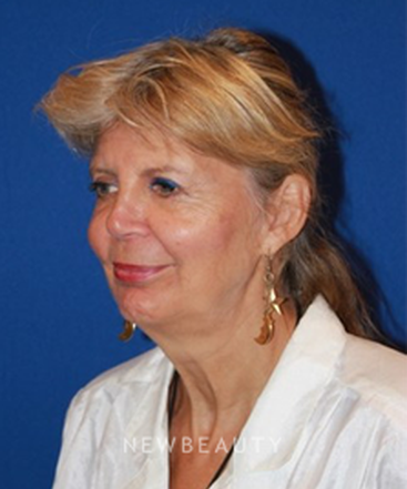 dr-dilip-madnani-facelift-b