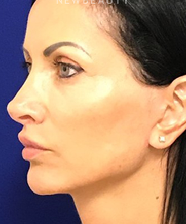 dr-dilip-madnani-minilift-injectables-b
