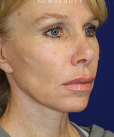 dr-dilip-madnani-mini-facelift-b