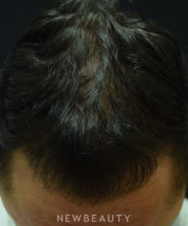 dr-jeffrey-b-wise-hair-transplant-b