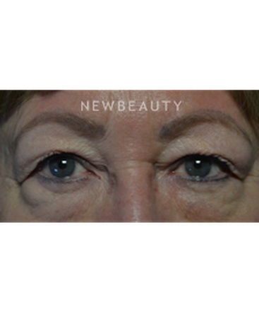 dr-baljeet-purewal-blepharoplasties-b