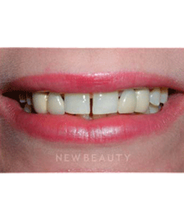 dr-guy-lewis-dental-implants-b
