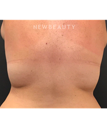 dr-janet-allenby-coolsculpting-b