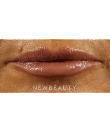 dr-marina-peredo-lip-augmentation-b