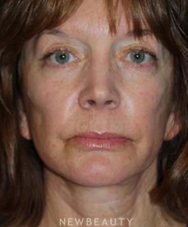 dr-brent-j-smith-facelift-with-fat-transfer-b