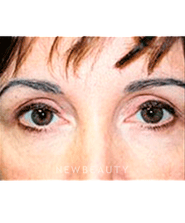 dr-sanjay-grover-blepharoplasty-b