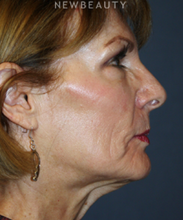 dr-brent-smith-facelift-with-fat-transfer-b