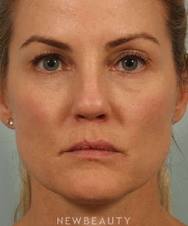 dr-kenneth-beer-natural-looking-rejuvenation-b