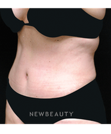 dr-andrew-smith-tummy-tuck-liposuction-b