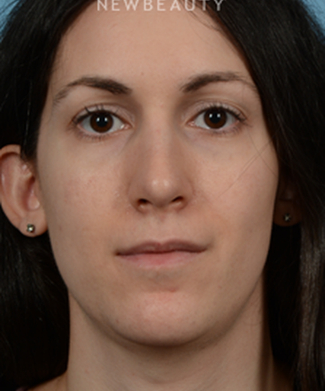 dr-jeffrey-wise-rhinoplasty-b