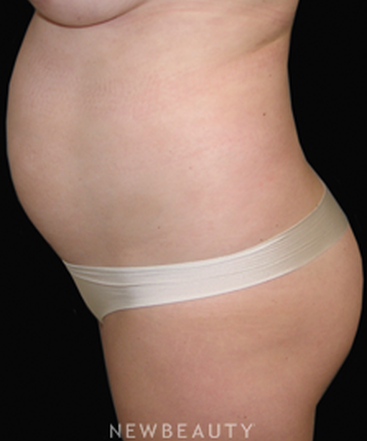 dr-sean-simon-laser-liposuction-b