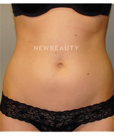 dr-sanjay-grover-liposuction-b