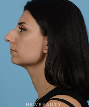 dr-jeffrey-b-wise-rhinoplasty-b