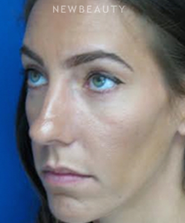 dr-joseph-russo-beautiful-results-eye-ebg-b