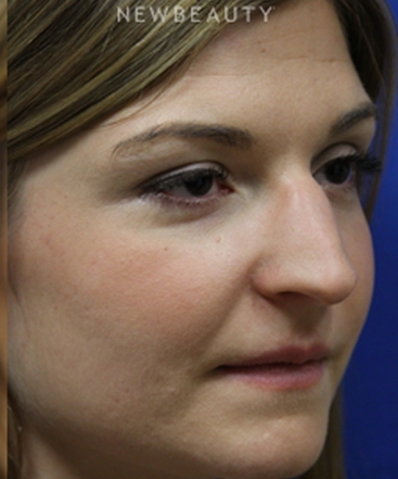 dr-jennifer-m-levine-revision-rhinoplasty-b