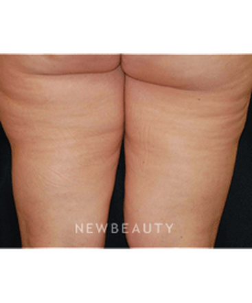 dr-kenneth-beer-lasers-cellulite-treatment-b