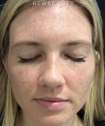 dr-kim-nichols-microneedling-b