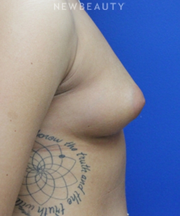 dr-joseph-russo-enhancing-curves-breast-ebg-b