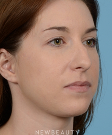 dr-jeffrey-wise-rhinoplasty-b