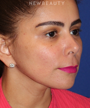 dr-dilip-d-madnani-mini-facelift-b