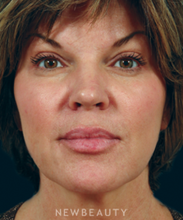 dr-kenneth-beer-restylane-b