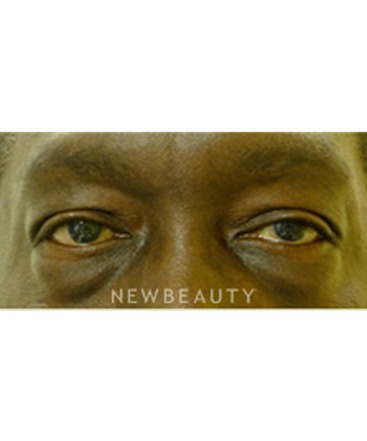 dr-baljeet-purewal-lower-blepharoplasty-b