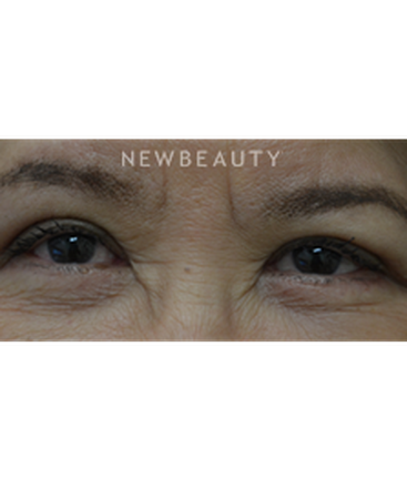 dr-baljeet-k-purewal-blepharoplasty-b