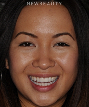 dr-ronald-goldstein-smile-makeover-b