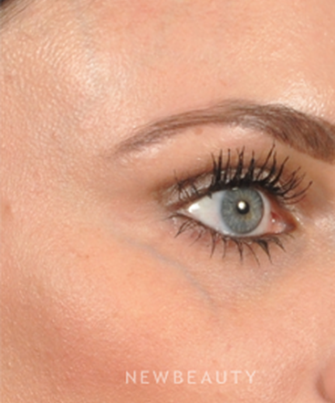 dr-bradley-bengtson-periorbital-vessel-treatment-b