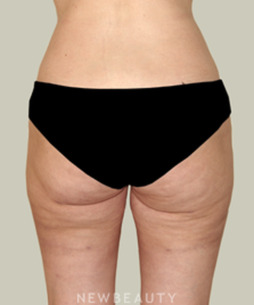 dr-david-rapaport-liposuction-b