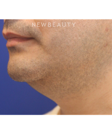 dr-jennifer-levine-coolsculpting-b