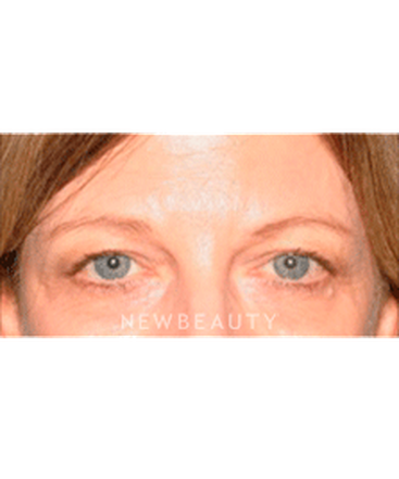 dr-sanjay-grover-blepharoplasty-b