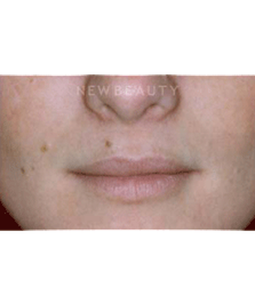 dr-charles-crutchfield-aesthetic-injectables-b