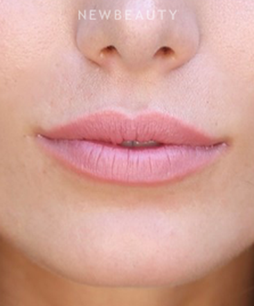 dr-sanjay-grover-restylane-silk-b
