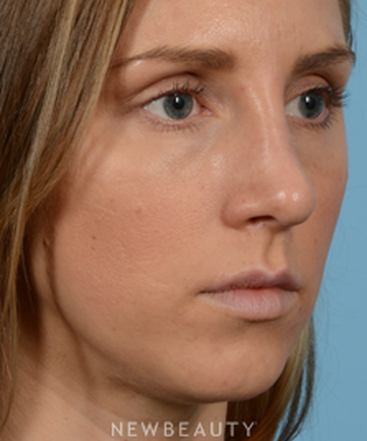 dr-jeffrey-wise-rhinoplasty-b