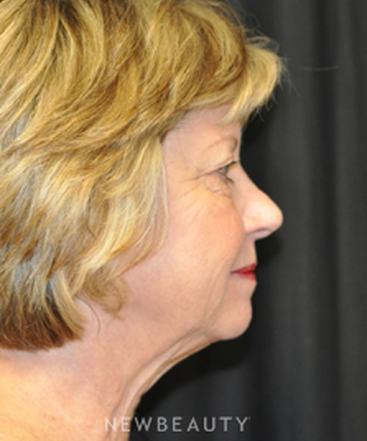dr-andrew-smith-facelift-eyelift-necklift-b