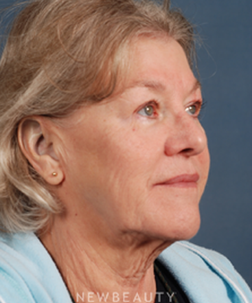 dr-bradley-calobrace-facelift-b