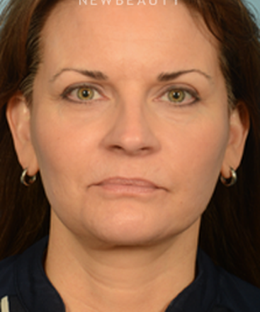 dr-bryan-gawley-facelift-b