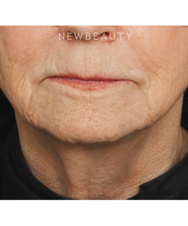 drs-jennifer-segal-scott-smith-injectables-fillers-b
