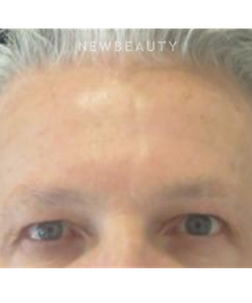 dr-kim-nichols-botox-b