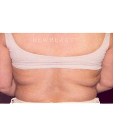 dr-charles-crutchfield-coolsculpting-by-zeltiq-b