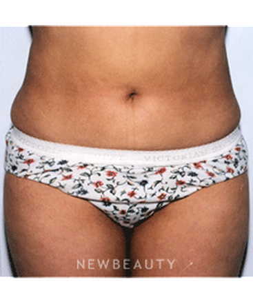 dr-david-rapaport-liposuction-b