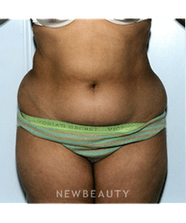 dr-david-rapaport-liposuction-b
