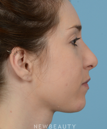 dr-jeffrey-wise-rhinoplasty-b