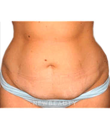 dr-sanjay-grover-tummy-tuck-b