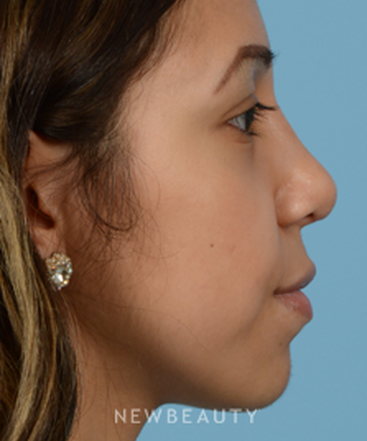 dr-jeffrey-b-wise-rhinoplasty-b