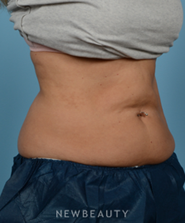 dr-jeffrey-wise-coolsculpting-b